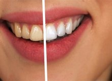 Αμερικάνικη μέλετη δείχνει ότι το ηλεκτρονικό τσιγάρο δεν προκαλεί κηλίδες στα δόντια όπως το κάπνισμα